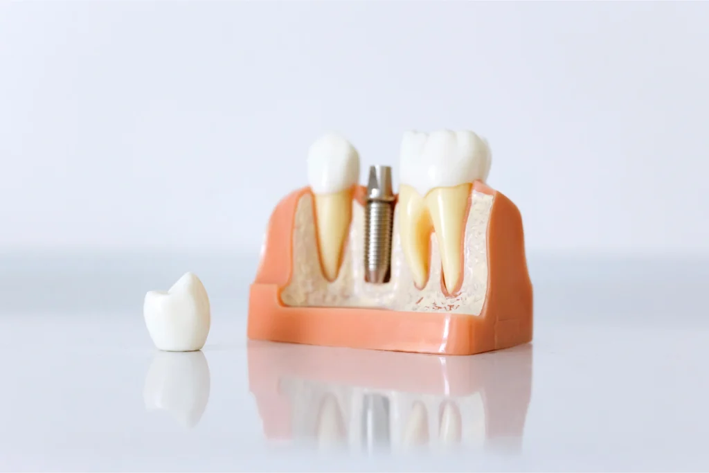 Implantologia dentale